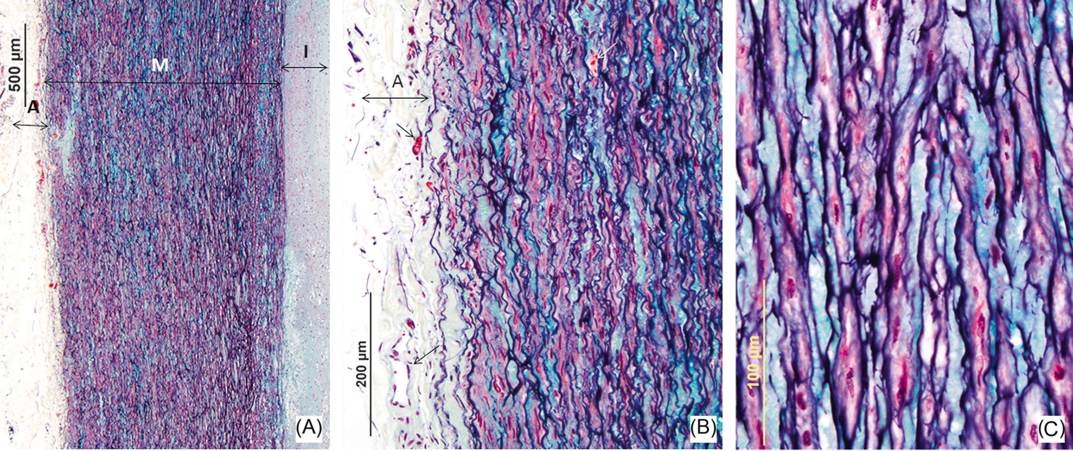 Figure 9.2, Aorta histology: (A) All vessels including the aorta have three histologic layers, the intima (I), media (M), and adventitia (A). The intima consists of an endothelial cell layer overlying a thin layer of connective tissue. A higher magnification of the media and adventitia is shown on the right; (B) the media forms the major part of the vessel wall and consists of concentric fenestrated lamellae of elastic tissue with smooth muscle cells, proteoglycans ( green ), collagen fibers, and microfibrils of elastin in between the large elastic lamellae. The adventitia is composed of collagen and elastic fibers with fibroblasts and interspersed vasa vasorum ( black arrows ). Blood vessels (vasa vasorum), which supply the arterial wall, also reside in the outer one-third of the media ( white arrow ) in the ascending aorta. (C) shows the high power of the media wall; note parallel elastic lamellae with smooth muscle cells, proteoglycans and collagen in between the lamellae. Collagen provides the strength to the aortic wall.