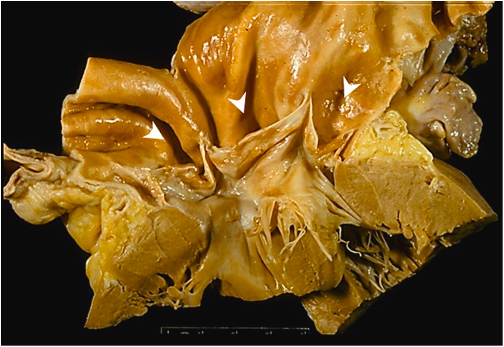 Figure 9.3, Marfan syndrome with annuloaortic ectasia in the absence of dissection. This 32-year-old man died suddenly. At autopsy, there were classic features of Marfan syndrome, and the aortic root was markedly dilated with involvement of all three aortic sinuses ( arrowheads ), the annulus, and the ascending aorta. The aortic root was 55 mm in diameter, and the aortic valve was insufficient. [34] .