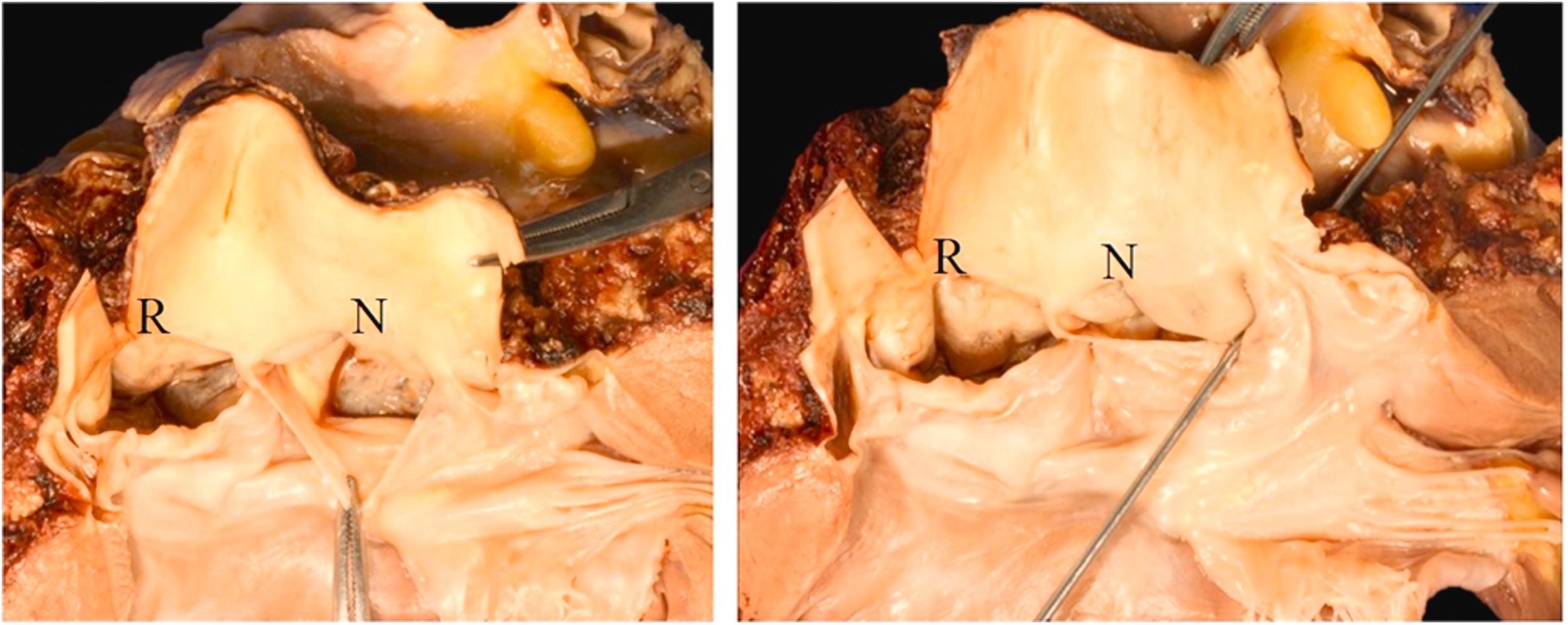 Figure 9.5, Sinus of Valsalva aneurysm involving right (R) and noncoronary (N) sinus with rupture through the noncoronary sinus into the right atrium indicated by the probe. The subject was a 35-year-old male who complained to a coworker of shortness of breath and then collapsed and could not be resuscitated. He had a history of atrial fibrillation, hypertension, and dilated aortic root.