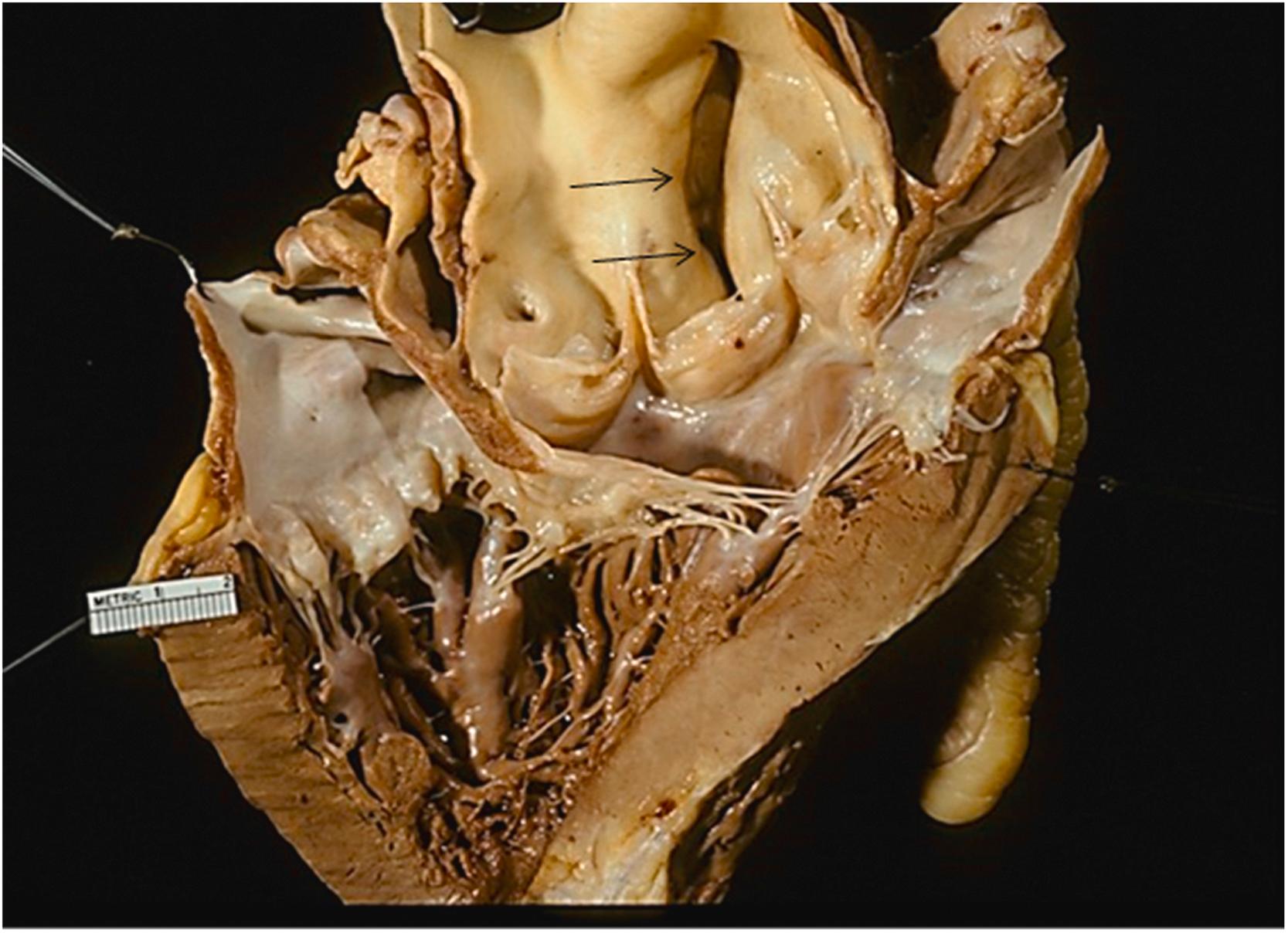 Figure 9.6, Marfan syndrome annuloaortic ectasia with dissection in a 23-year-old man who died suddenly. At autopsy, he had classic features of Marfan syndrome. Note the annuloaortic ectasia with a longitudinal intimal tear ( arrows ).