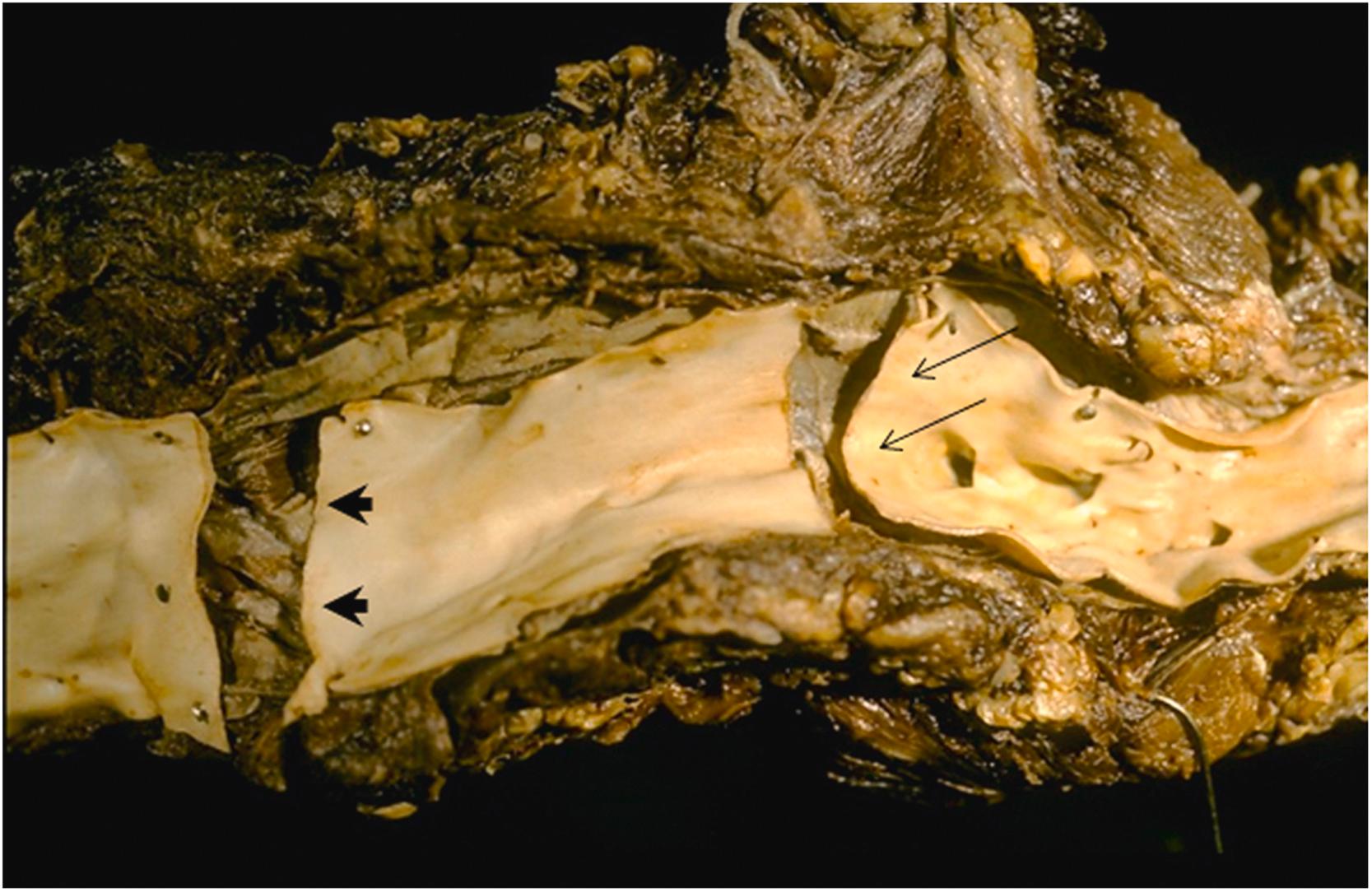 Figure 9.7, Ehlers–Danlos syndrome, vascular type, affecting a 14-year-old black boy who complained of chest and abdominal pain while lifting weights; emergency computed tomographic (CT) scan showed an aortic dissection and rupture, and the patient expired shortly afterward. He had history of easy bruising and poor wound healing, was 6′1″ tall and weighed 123 lb. At autopsy, he had a hemothorax and the aorta was transected transversely just distal to the left subclavian artery origin ( arrows ) and just proximal to the celiac artery ( arrowheads ).