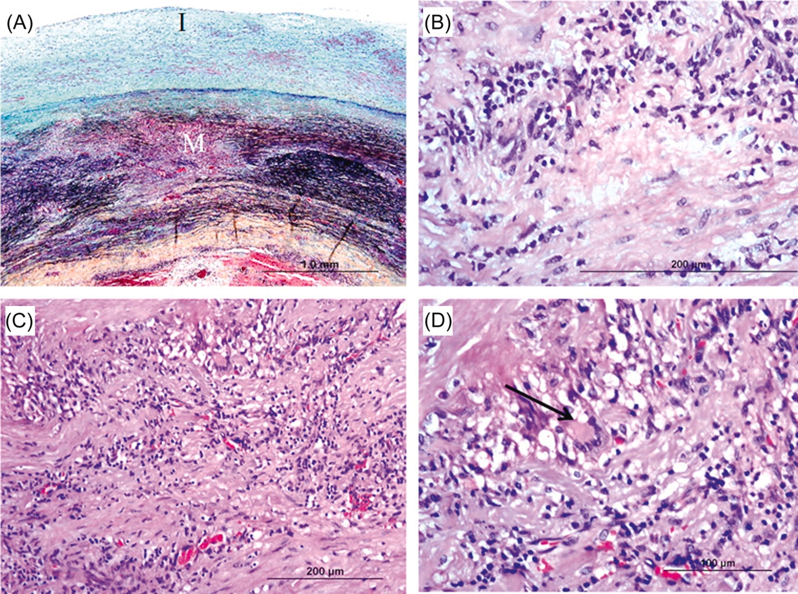 Figure 9.8, Histologic images show ascending aortitis. (A) There is intimal (I) thickening and medial (M) necrosis (Movat stain). (B) and (C) show marked chronic inflammation (lymphocytes and plasma cells) with scattered multinucleated giant cells ( arrow ) in (D) (H&E). At the time of aortic resection, the patient had no clinical history of systemic disease suggesting a diagnosis of isolated aortitis.