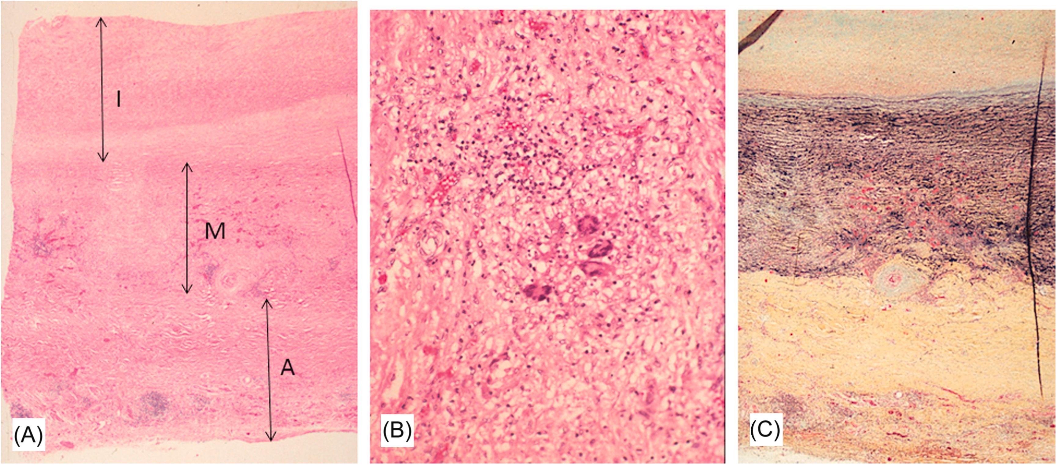 Figure 9.10, Takayasu’s aortitis. (A) Low-power view of the thoracic aorta showing marked thickening of the adventitia (A) and moderate intima (I) thickening. The media shows focal destruction and inflammation (H&E stain). (B) High-power view demonstrating destruction of the media and marked inflammation consisting of lymphocytes, macrophages, and giant cells (H&E stain). (C) Movat pentachrome-stained section demonstrating as shown in (A), medial disruption by inflammatory infiltrate and both fibrointimal and adventitial thickening. Note endarteritis obliteration of the vasa vasorum.