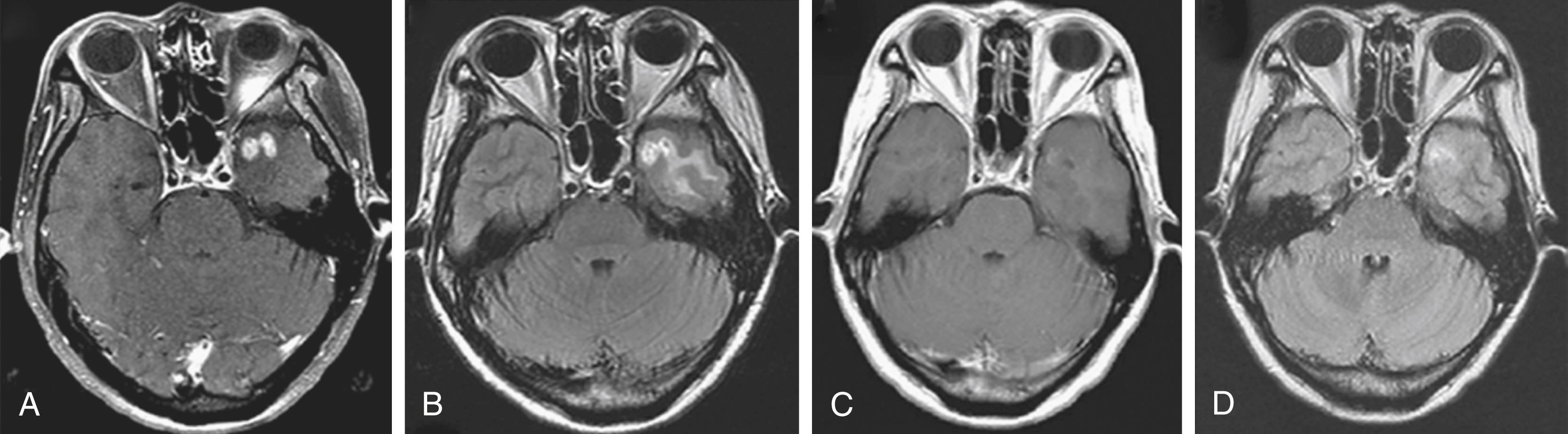 Figure 140.11, Bevacizumab reverses radiation necrosis.