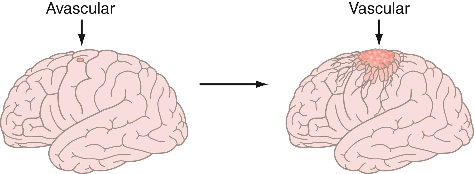 Figure 140.2, The hypothesis of an angiogenic switch that is critical to the growth of an individual tumor from an asymptomatic, covert cluster of cells lacking a blood supply (left) to the clinically overt, highly vascular, symptomatic tumor (right).