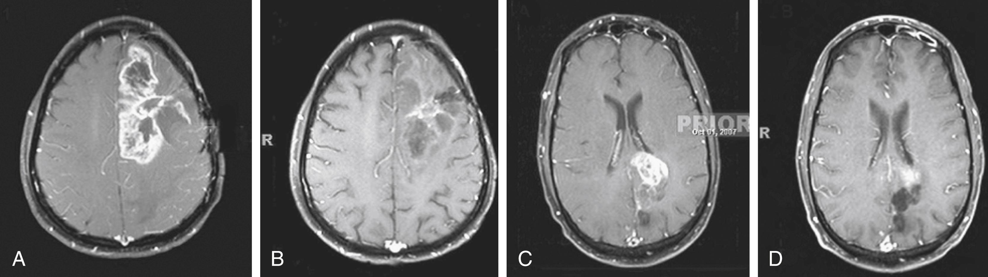 Figure 140.4, MRI response of glioblastoma to antiangiogenic therapy using bevacizumab and irinotecan, examples of “pharmacologic debulking.”