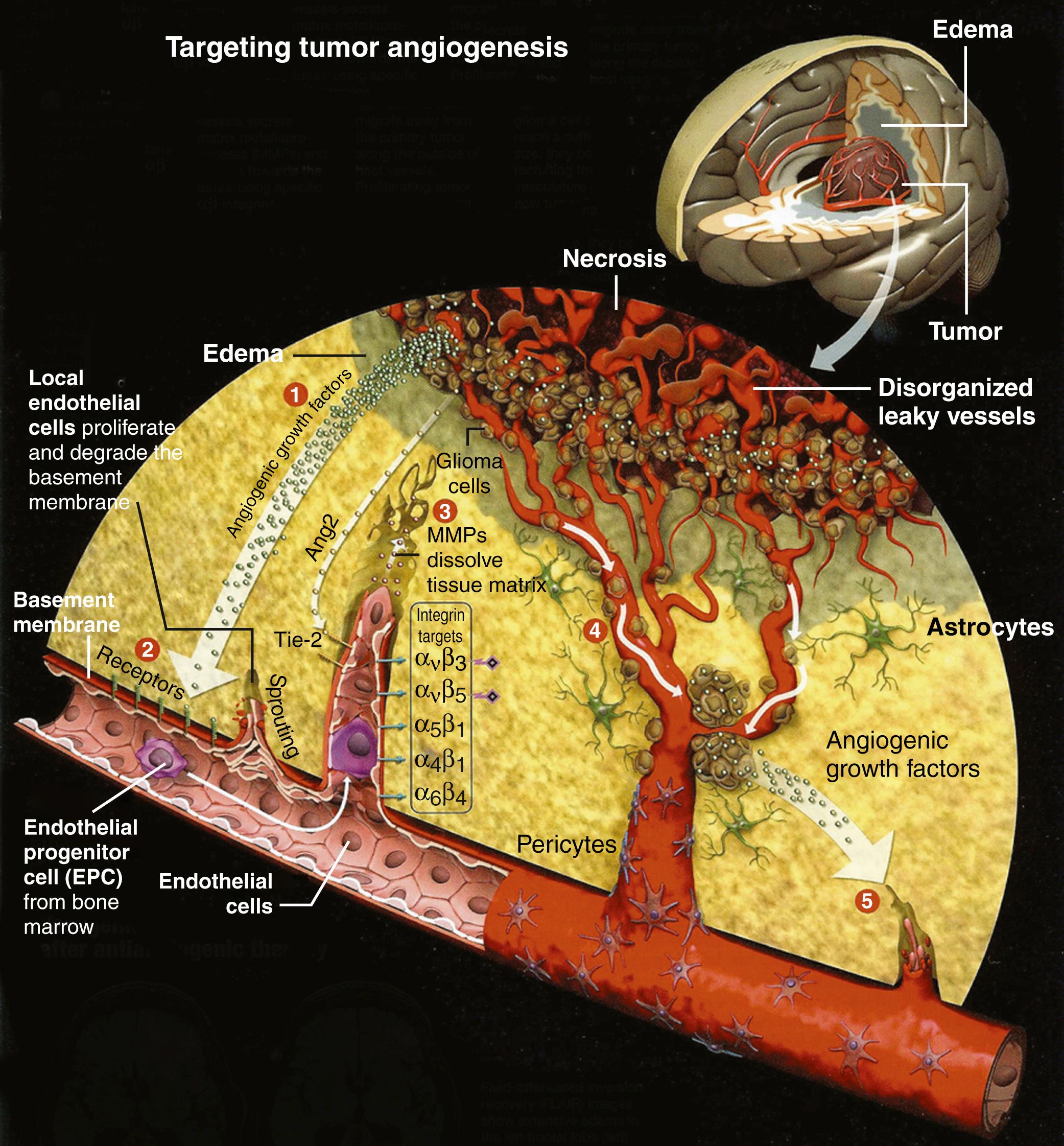 Figure 140.6, Key steps in the angiogenic switch in human glioblastoma.