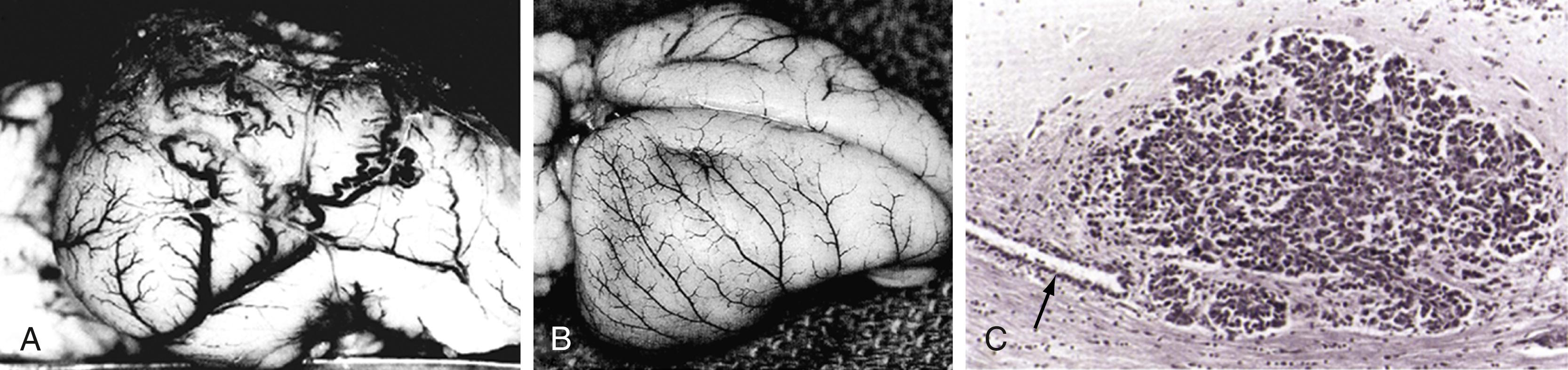 Figure 140.7, Brain tumor angiogenesis, anti–vascular endothelial growth factor (VEGF) normalization, and vascular co-option in an animal model.