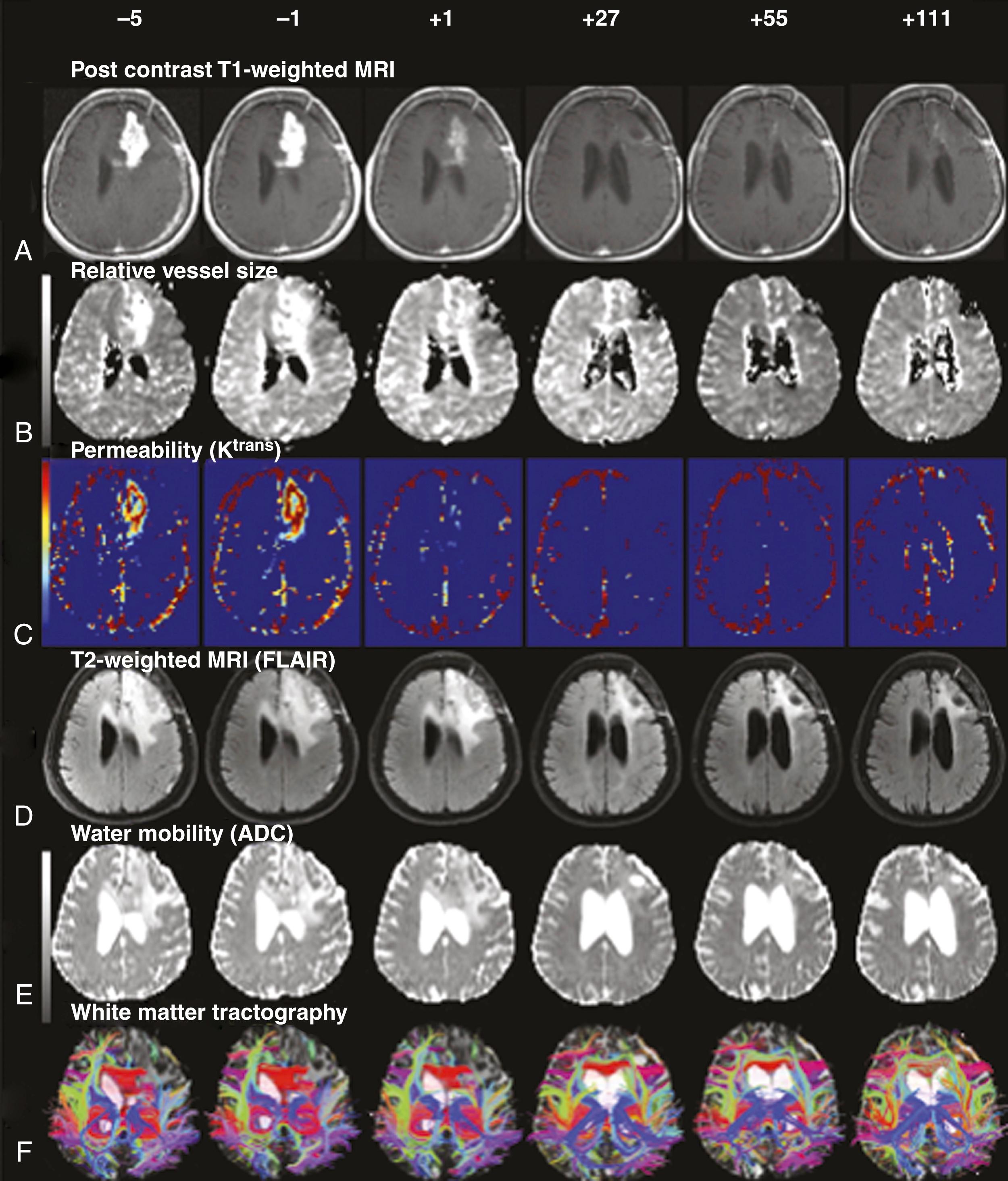 Figure 140.10, Neuroimaging techniques to detect the normalization window in a patient with a recurrent glioblastoma treated with targeted antiangiogenic therapy (cediranib).