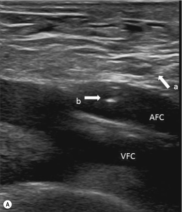 Fig. 78.2, (A) This shows the tip of the needle entering the common femoral artery ( AFC, common femoral artery; VFC, common femoral vein; a, ultrasound needle track; b, tip of the needle). (B) A guidewire has been passed into the superficial femoral artery (AFS), avoiding inadvertent passage into the profunda femoris artery (AFP) .