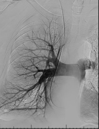 Figure 10.1, Frontal digital subtraction angiogram with a catheter in the right pulmonary artery demonstrating the normal branching anatomy of the pulmonary arteries.