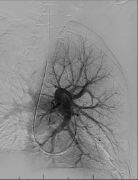 Figure 10.2, Digital subtraction angiogram, right anterior oblique projection, with the catheter tip in the right pulmonary artery demonstrating the normal anatomy.