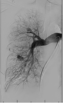 Figure 10.3, Arterial phase digital subtraction angiogram with the catheter in the right pulmonary artery demonstrates two pulmonary arteriovenous malformations.