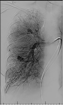 Figure 10.4, Venous phase digital subtraction angiography with the catheter in the right pulmonary artery demonstrates pulmonary arteriovenous malformations with the hypertrophied early draining veins.