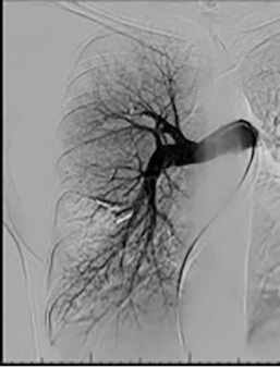 Figure 10.5, Arterial phase digital subtraction angiography with the catheter in the right pulmonary artery demonstrates complete occlusion of the pulmonary arteriovenous malformations after coil embolization.