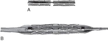 FIG 24.2, (A) The Palmaz stent is crushed to a small caliber and mounted on an angioplasty balloon. Sizes most commonly used for iliac interventions are already premounted by the manufacturer. (B) The Palmaz stent is deployed by inflating the angioplasty balloon.