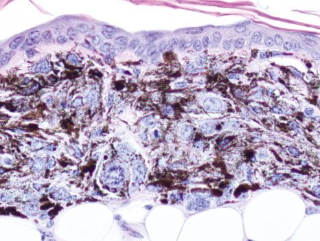 Fig. 36.11, Melanoma histology in the Braf/Pten genetically engineered mouse model. Pigmented junctional melanoma on the ear following perinatal 4-hydroxytamoxifen induction.