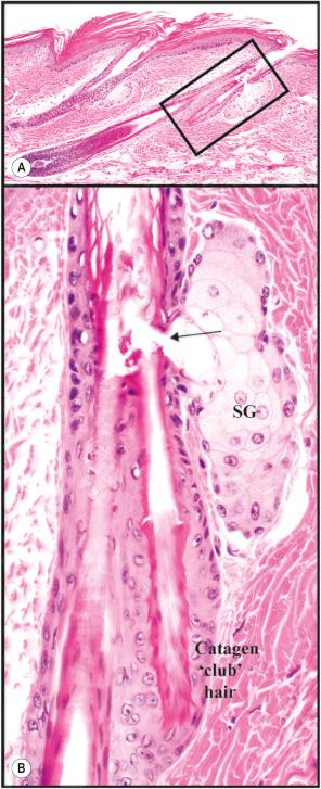 Fig. 36.4, Tail skin has large hair follicles: ( A ) this one being in late anagen. The overlying epidermis is normally thick and more cornified when compared to the truncal skin. ( B ) The boxed area shows the sebaceous gland (SG) and its duct ( arrow ) where the inner root sheath degrades allowing the hair shaft to emerge. The club hair, remnant of the last hair cycle, is pushed to the side when the new hair follicle develops.