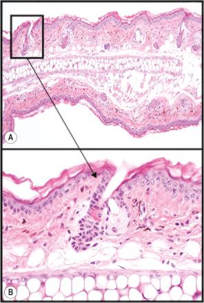 Fig. 36.5, Normal ear skin has small follicles in prolonged telogen stage. Note the auricular cartilage extending down the middle of the tissue (A). Enlargement of boxed area shows detail of the epidermis, telogen hair follicle, and auricular cartilage (B).