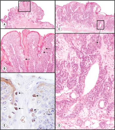 Fig. 36.8, Laboratory mouse papillomavirus infections cause exophytic papillomas on the muzzle ( A , B ) and tail that are productive (viral antigens can be detected in koilocytes by immunohistochemistry, E ). However, when the virus was inoculated into the dorsal skin in the lumbar region, a slightly raised lesion developed with poorly differentiated cells that were locally invasive ( C , D ). These cells had a high nuclear to cytoplasmic ratio, high mitotic index, and were positive for several mouse specific keratins by immunohistochemistry.