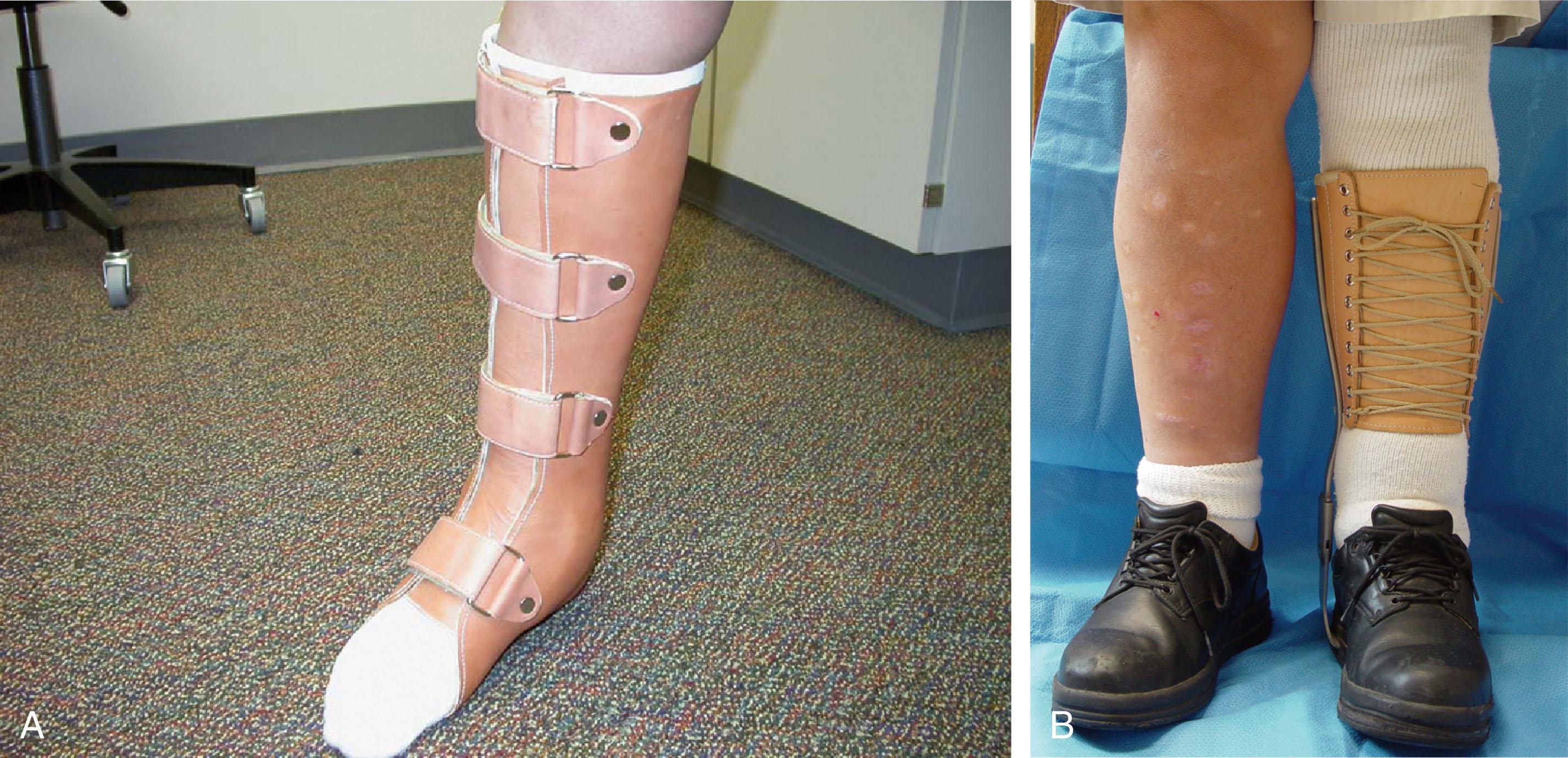 Fig. 22-11, Brace treatment of ankle arthritis is directed at limiting motion and reducing axial loading. The two braces we use are a custom-made leather-lined polypropylene ankle–foot orthosis (A) and a calf lacer with metal drop locks fitted to a rocker-bottom shoe (B) . These usually are made with lace-up straps, but they can be fitted with hook-and-loop (Velcro) straps, as shown in (A) , for patients with profound loss of grip strength from end-stage rheumatoid disease.