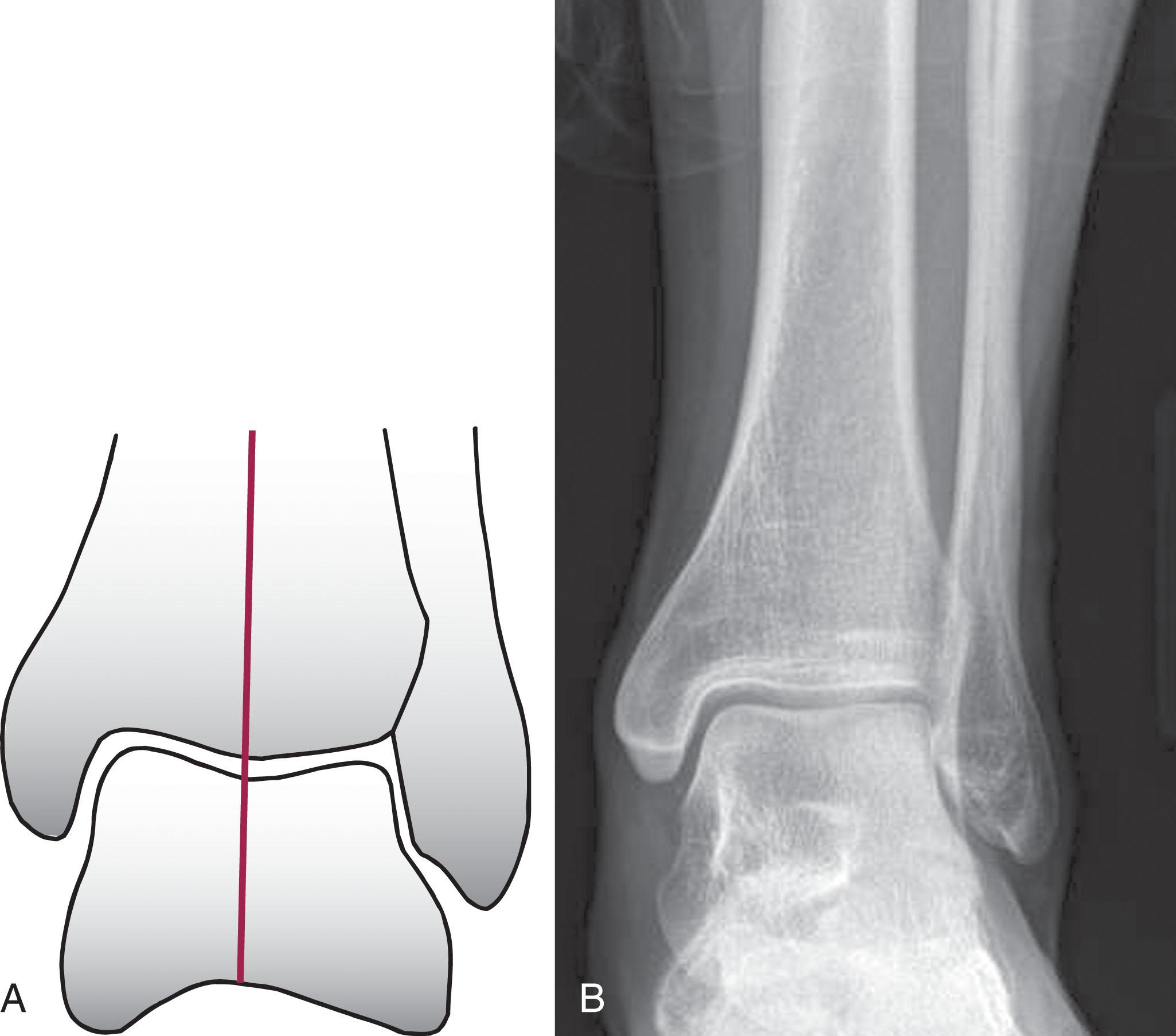 Fig. 22-2, Ankle joint anatomy. A , The drawing shows how the talus fits in the mortise formed by the distal ends of the fibula and tibia, similar to a mortise and tenon joint in carpentry. The medial malleolus and the medial surface of the talus form the opposing medial articular surfaces, the distal tibia and the superior talus form the opposing central articular surfaces, and the lateral malleolus and the lateral surface of the talus form the opposing lateral articular surfaces. The convexity of the distal tibial articular surface matches the concavity of the superior talar articular surface, forming a highly congruent joint surface. The center of the matching convexity and concavity is used to divide the joint into medial and lateral compartments for the study of joint loading and joint degeneration. B , Standing radiograph of the ankle joint showing the features outlined in the drawing.