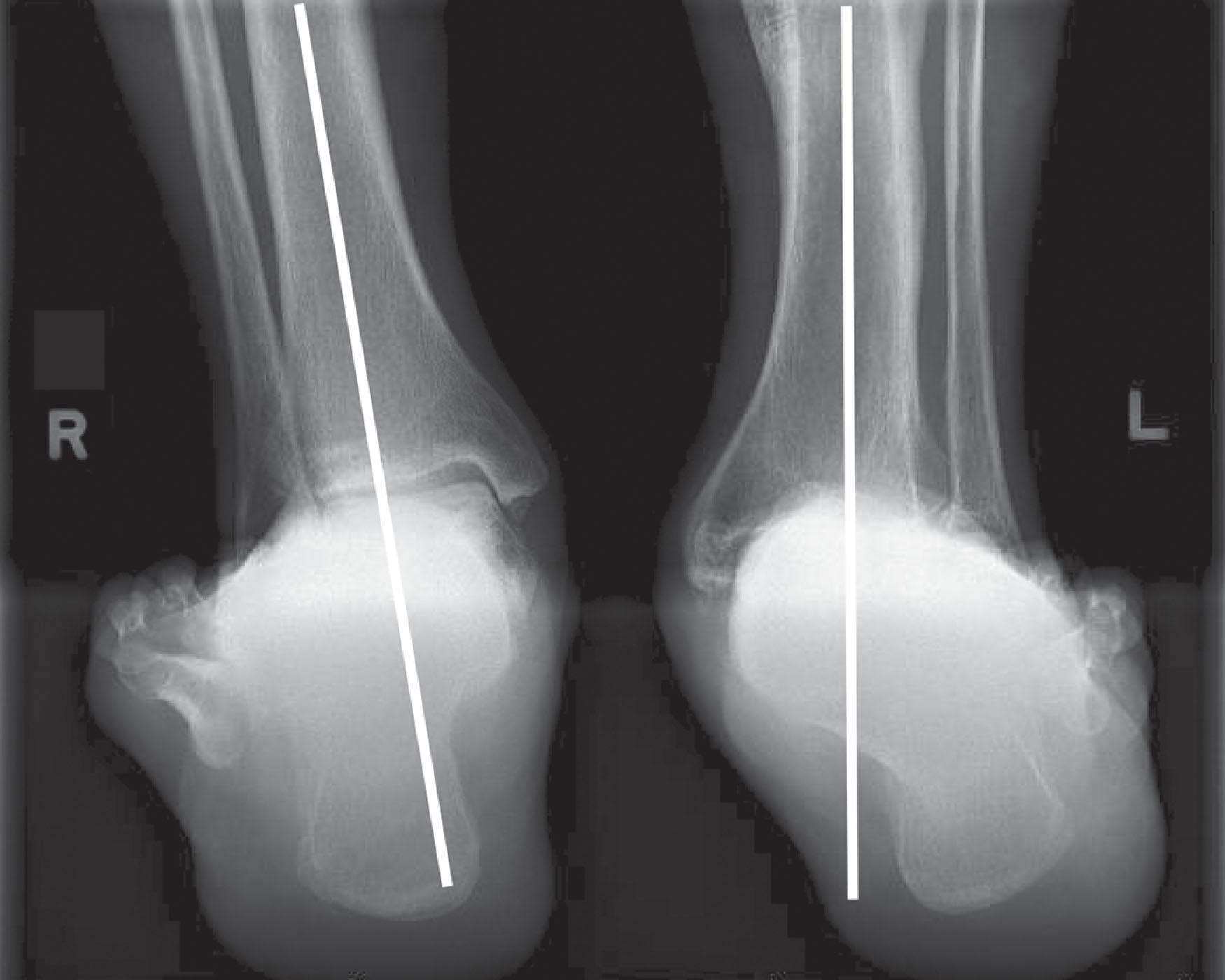 Fig. 22-5, The hindfoot alignment view is taken with the patient standing on a platform, with the toes pointed straight ahead at the film plate. The x-ray beam is directed toward the ankle in a posterior to anterior direction, tilted 20 degrees caudad. The film is placed near the toes, also tilted 20 degrees, oriented exactly perpendicular to the beam. 250 A line passing down the central longitudinal axis of the tibia should bisect the medial 1/3–lateral 2/3 of the calcaneus as seen on the radiograph of the right ankle (R). The left ankle and hindfoot (L) is in considerable valgus.
