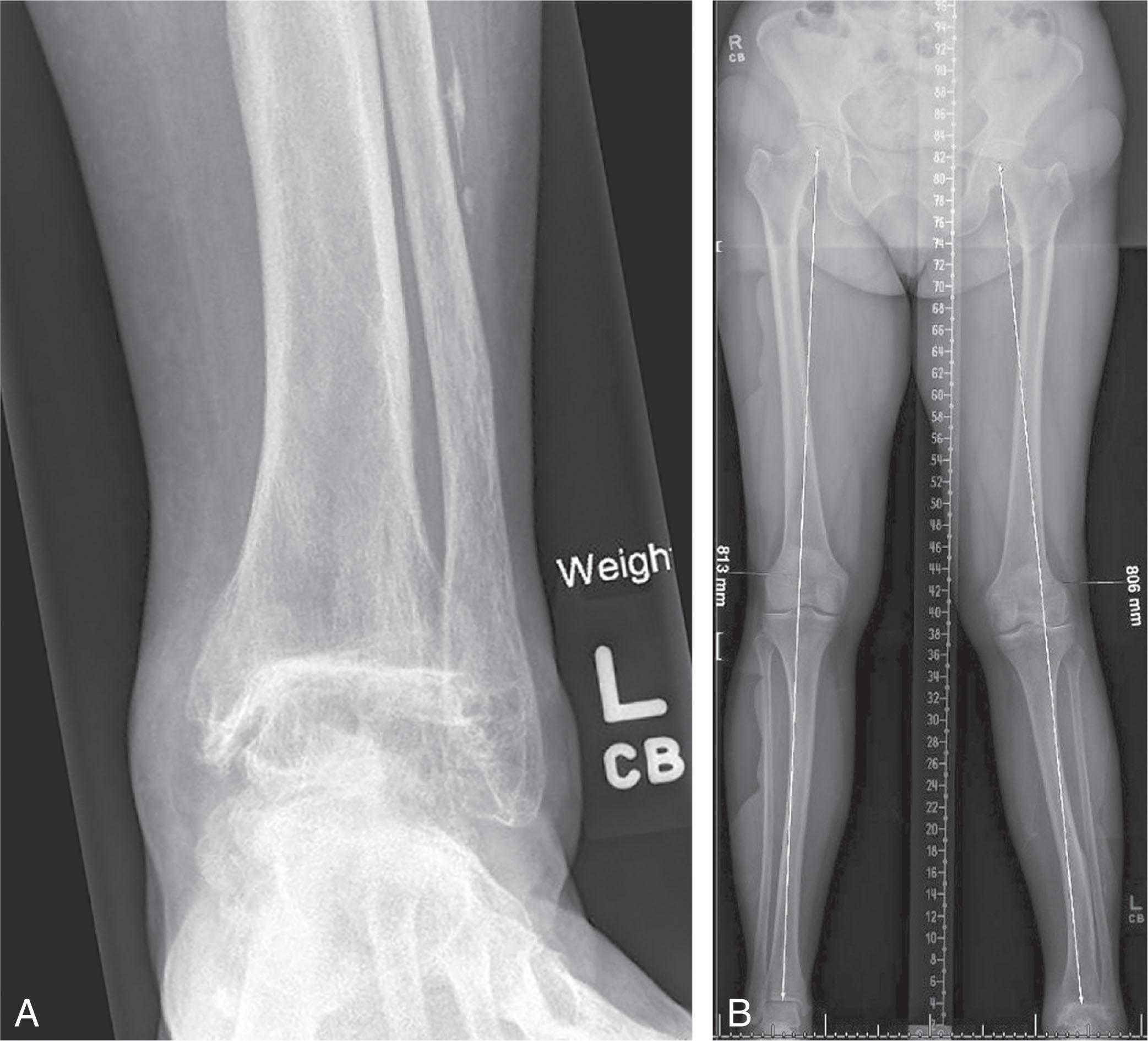 Fig. 22-6, A , The standard ankle radiograph may miss bone and joint deformity above the ankle. B , The long-leg alignment view is taken with the patient standing and includes the pelvis, femurs, tibias, and ankles. Varus deformity of the tibia and genu valgum from lateral knee osteoarthritis are revealed.