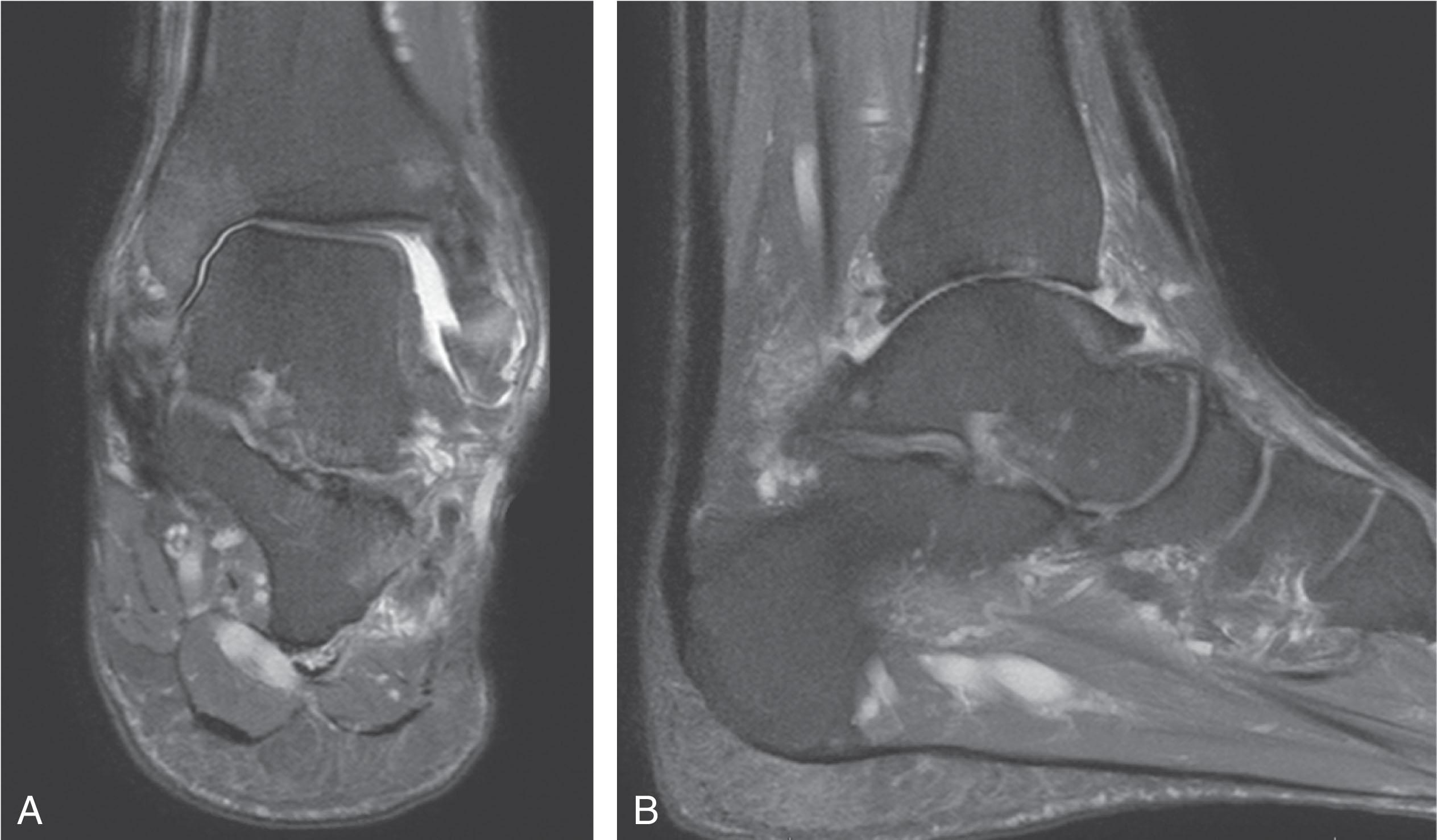 Fig. 22-7, A , Coronal and (B) sagittal T2 weighted images of an ankle with primarily medial sided ankle arthritis.