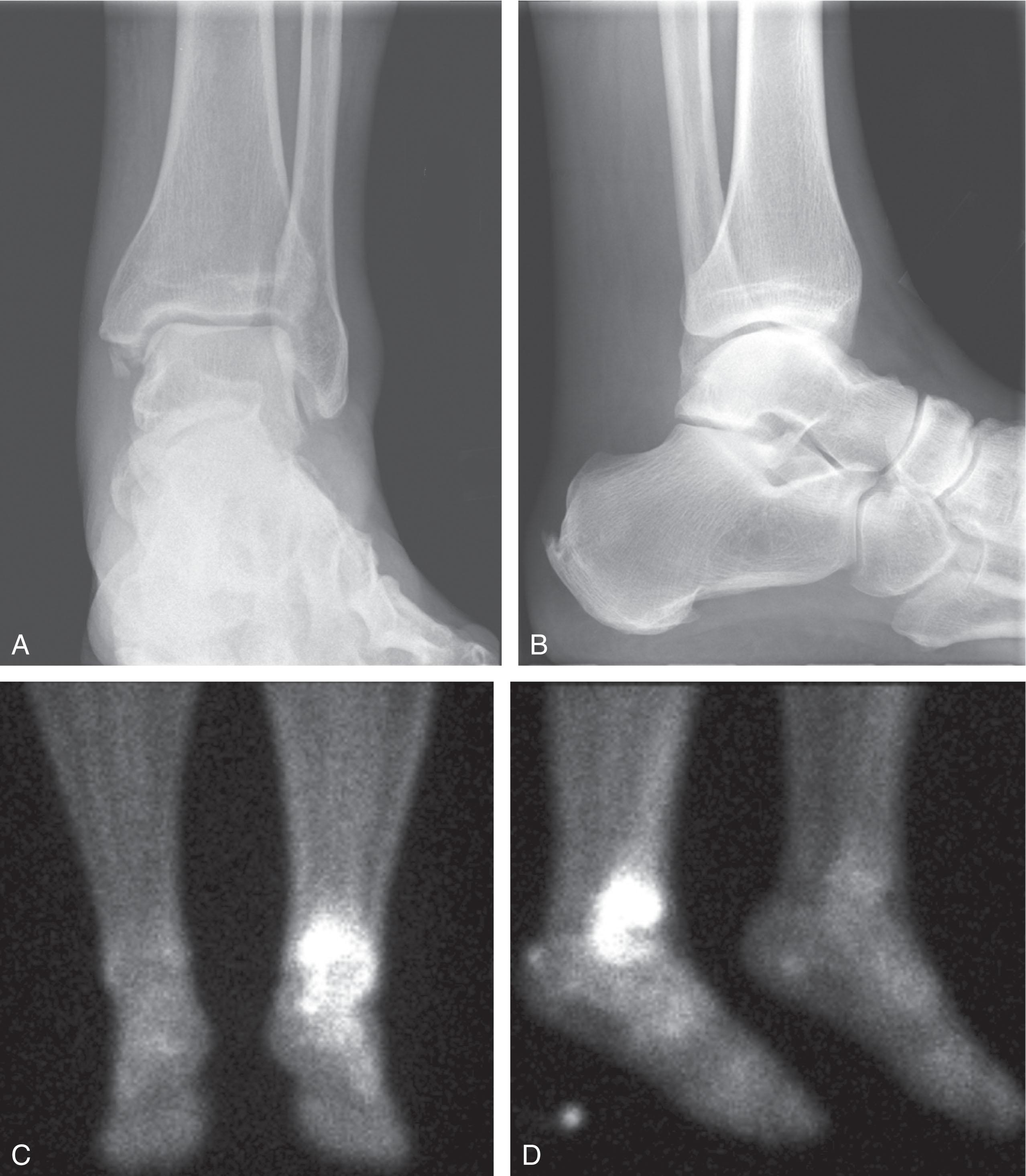 Fig. 22-9, A , AP and ( B ) lateral radiographs of a patient with early osteomyelitic arthritis do not show any abnormality. C , Coronal and ( D ) sagittal bone scan images of the same patient show marked uptake of radionucleotide uptake in the bones around the ankle.