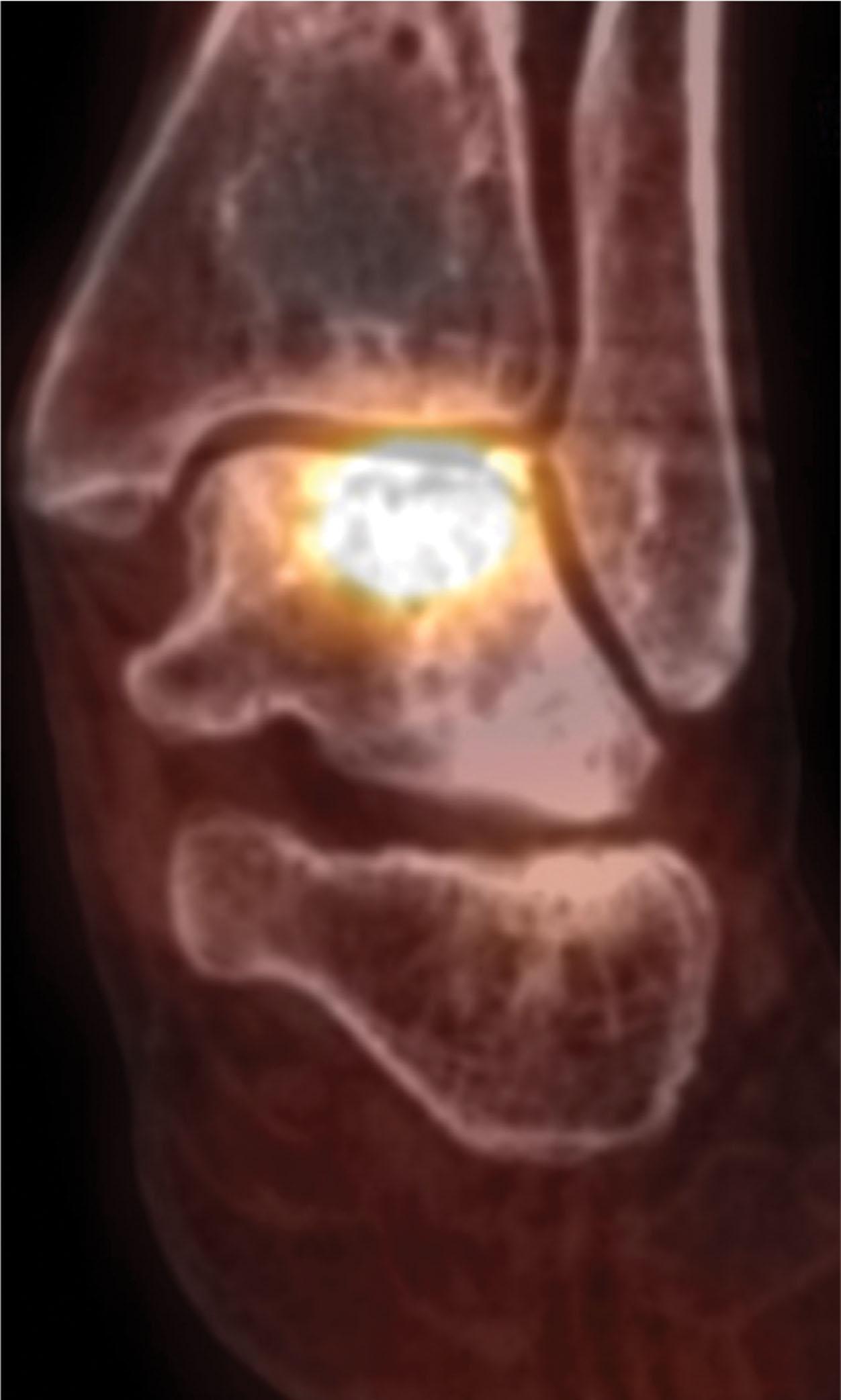 Fig. 22-10, Single photon emission computed tomography plus traditional computed tomography (SPECT-CT) improves the sensitivity and specificity of either a CT scan or bone scan alone. Areas of radionucleotide uptake are superimposed on images of the bony anatomy, allowing precise localization of areas of high bone turnover common in many pathologic conditions.