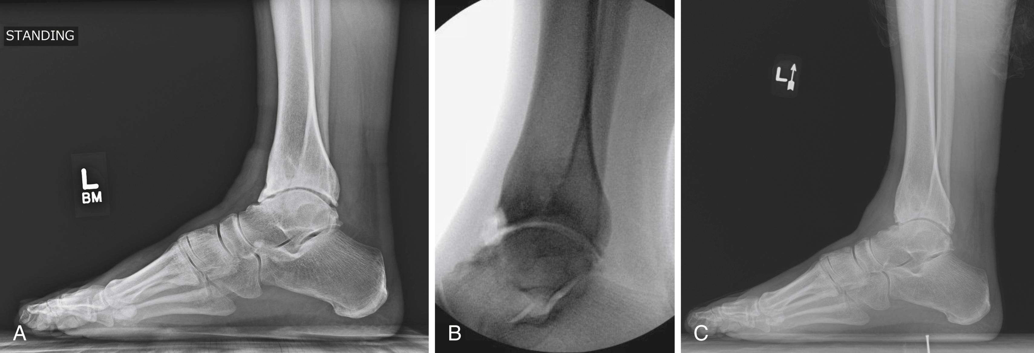 FIGURE 11.1, Joint debridement. A, Preoperative lateral radiograph. B, Intraoperative radiograph following anterior debridement of osteophytes. C, Postoperative lateral radiograph.