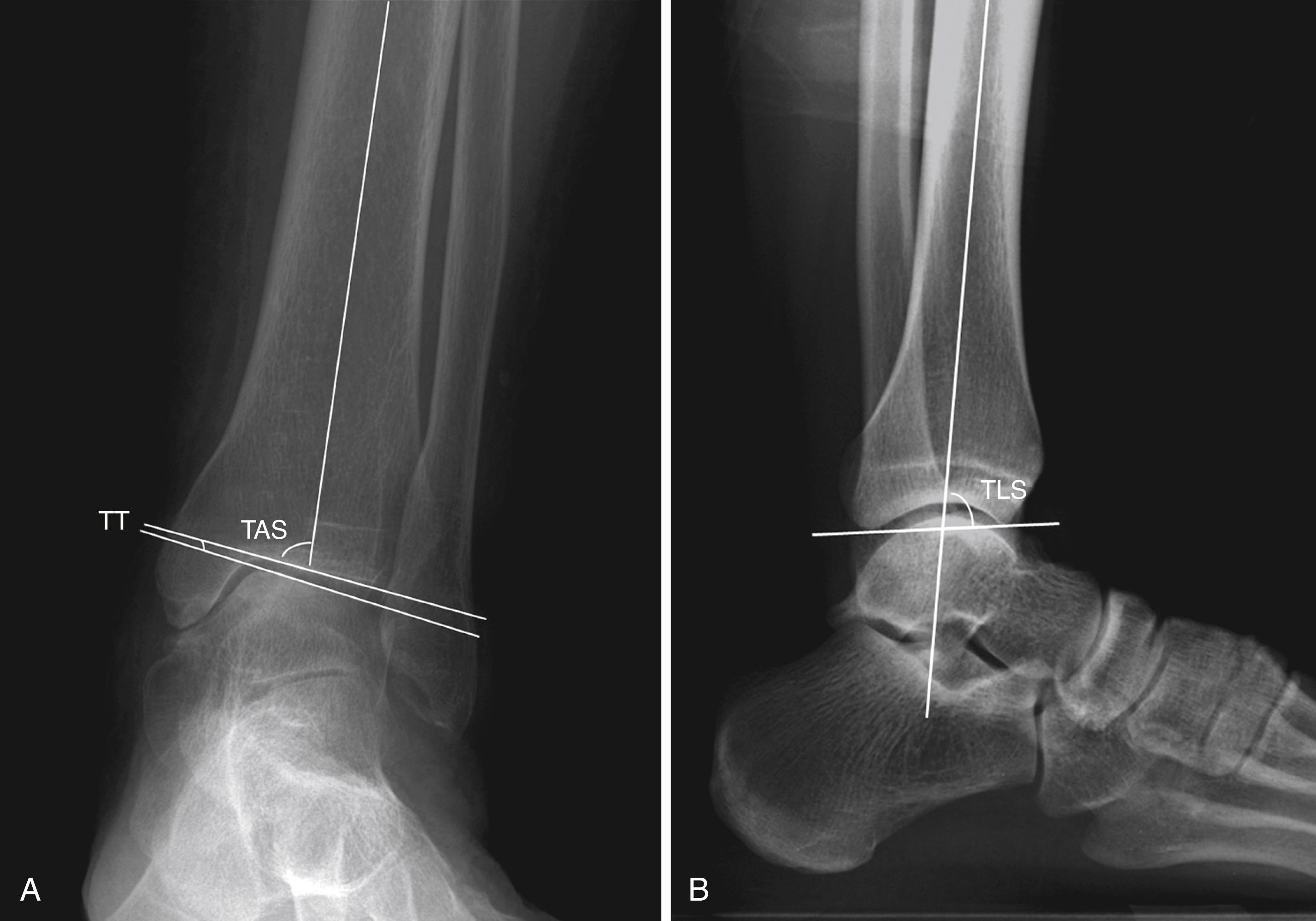 FIGURE 11.2, A, Anteroposterior weight-bearing radiograph showing measurement of tibial-ankle surface angle (TAS) and talar tilt angle (TT) . B, Lateral weight-bearing radiograph showing measurement of tibial-lateral surface angle (TLS) .