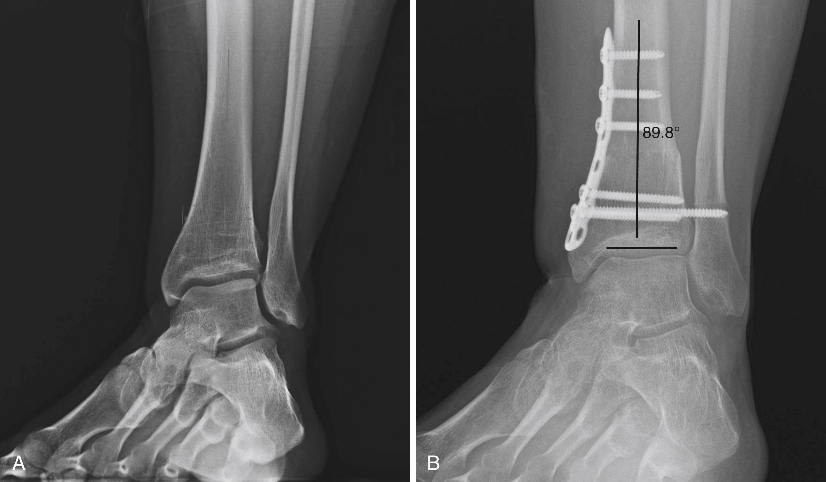 FIGURE 11.3, Medial closing wedge osteotomy for correction of supramalleolar deformity, preoperative ( A ) and postoperative ( B ) radiographs.