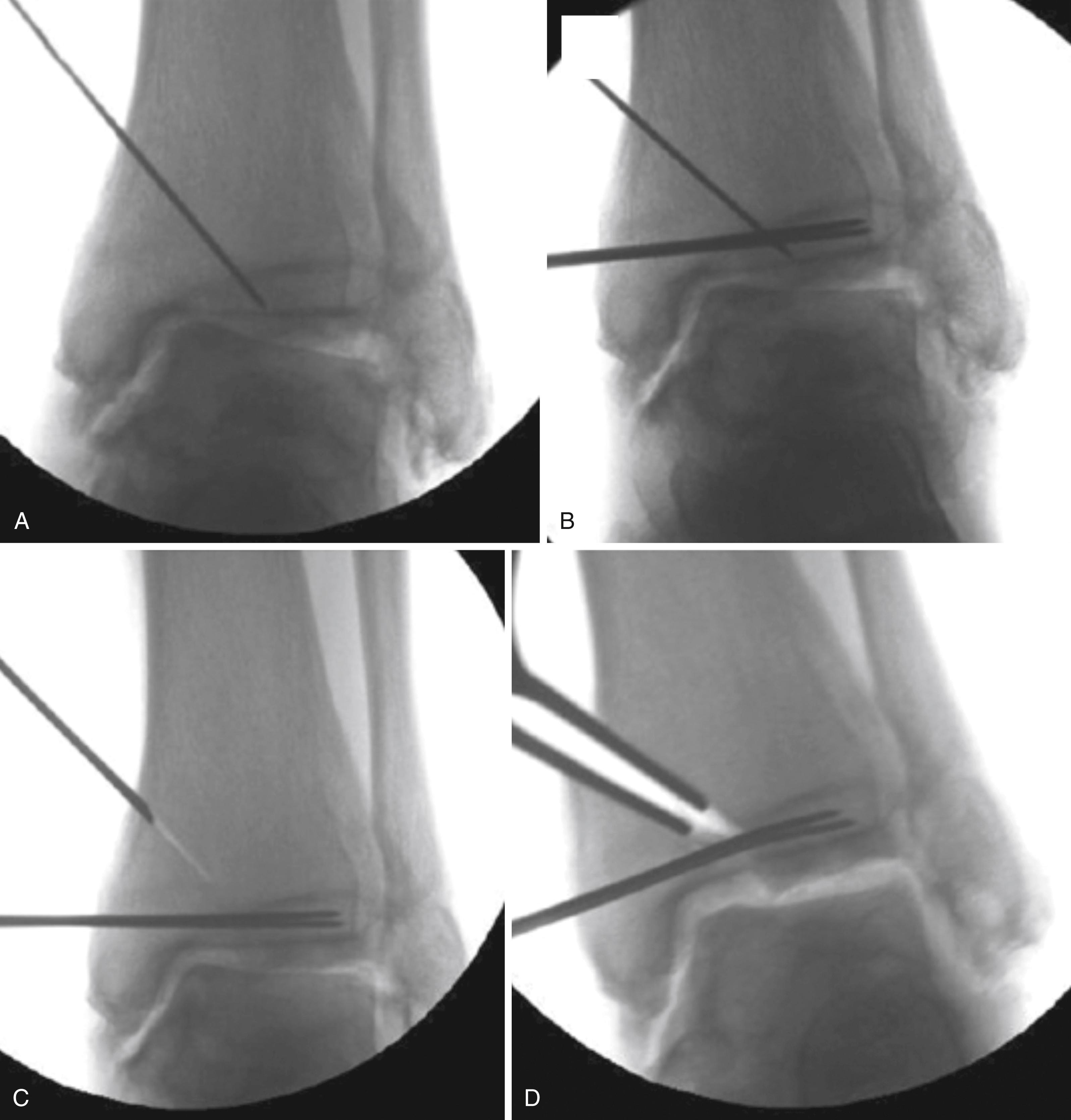 FIGURE 11.4, A , Guide pin inserted with tip positioned at the apex of the deformity. B , Kirschner wires inserted just proximal to the tibial plafond to prevent the saw from entering the joint. C , Osteotomy created with the saw aligned perpendicular to the coronal axis of the tibia. D , Displacement of the osteotomy with a lamina spreader for deformity correction.