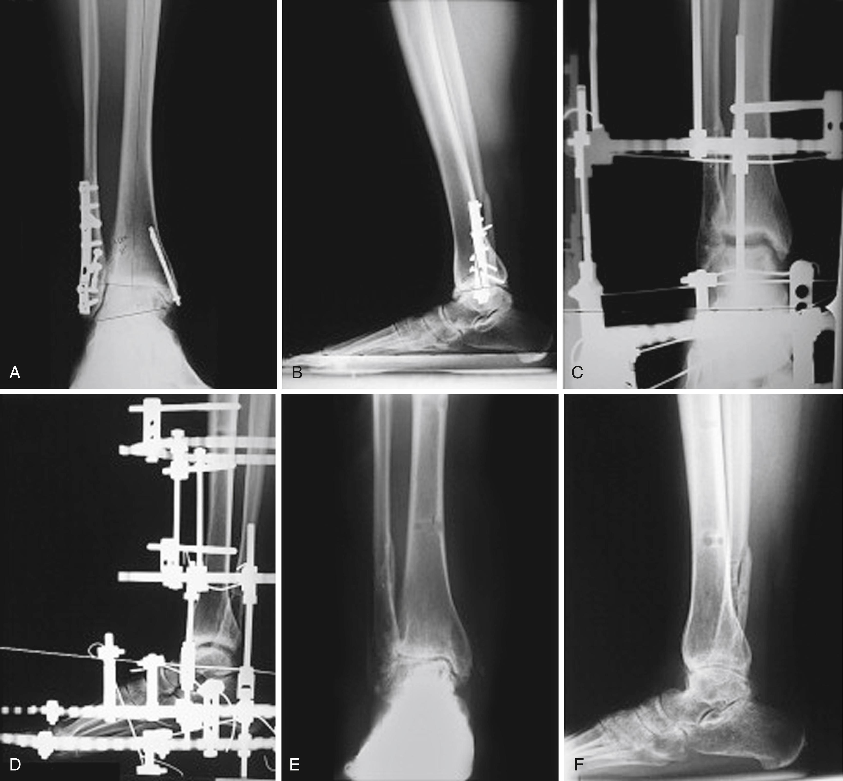 FIGURE 11.5, A and B, Posttraumatic arthritis and anterior osteophytes. C and D, Approximately 8 mm of ankle joint distraction obtained with hinged external fixation distraction device. E and F, Plantigrade foot at 3-year follow-up.