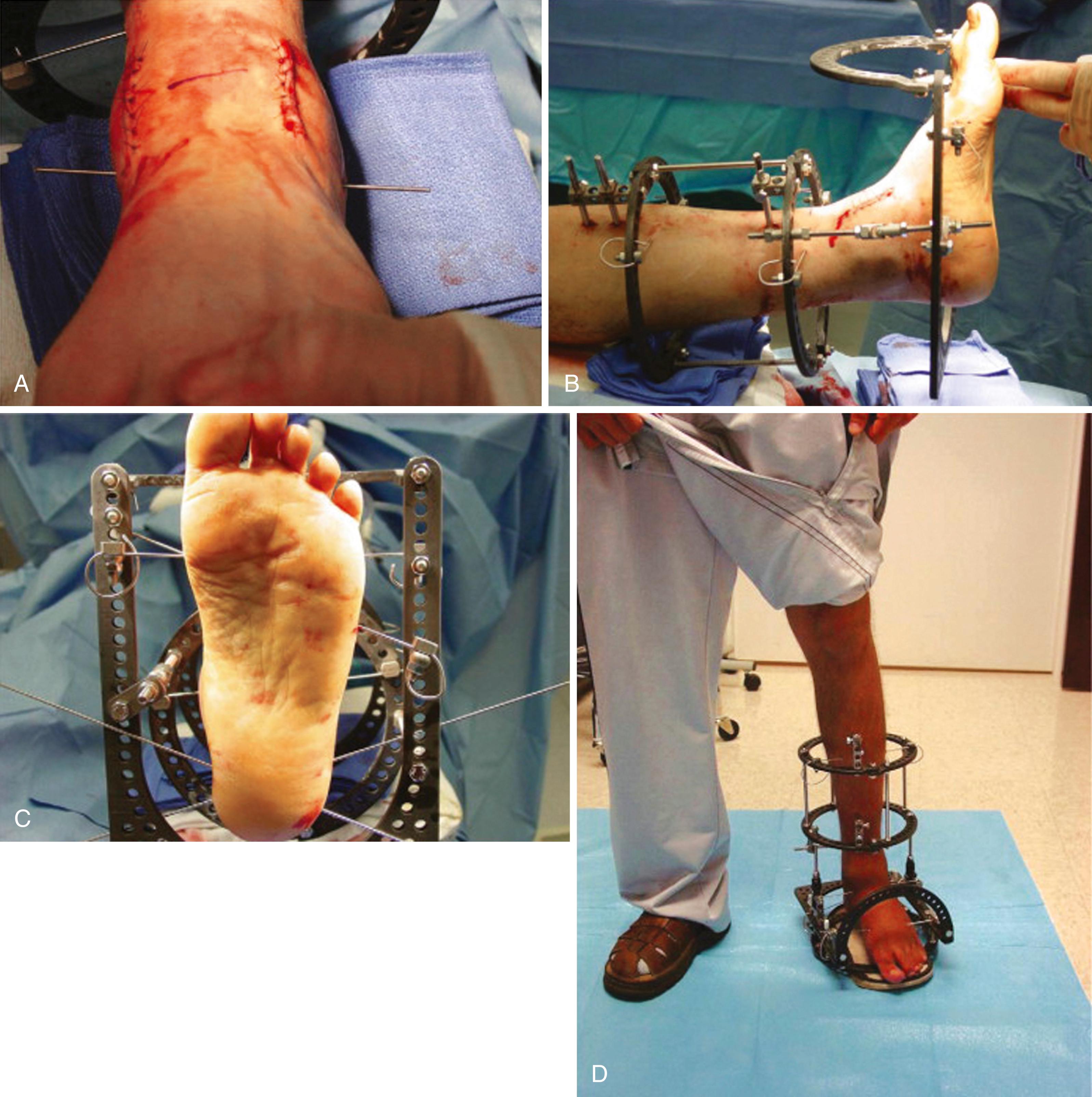 FIGURE 11.6, Distraction arthroplasty. A, Temporary guidewire inserted from tip of lateral malleolus to tip of medial malleolus as reference for ankle hinge placement. B, External fixator application. C, Wires placed in calcaneus and tensioned; note that foot is centered in fixator ring. D, Patient standing in frame with constrained ankle motion allowed through anatomically placed hinges.