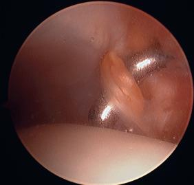 Fig. 115.2, An anterolateral soft tissue impingement lesion.