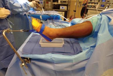 Fig. 115.3, Noninvasive distraction. The foot is attached to a disposable harness that is attached to the distractor along the side of the operating table.