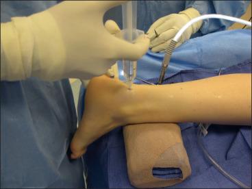 Fig. 115.4, The setup for posterior ankle endoscopic procedures. The needle is placed at the posterolateral portal, directed to the first web space, and placed parallel to the weight-bearing axis of the foot.