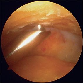 Fig. 115.6, Arthroscopic preparation of the tibiotalar joint; the subchondral surface is débrided with use of a motorized burr.