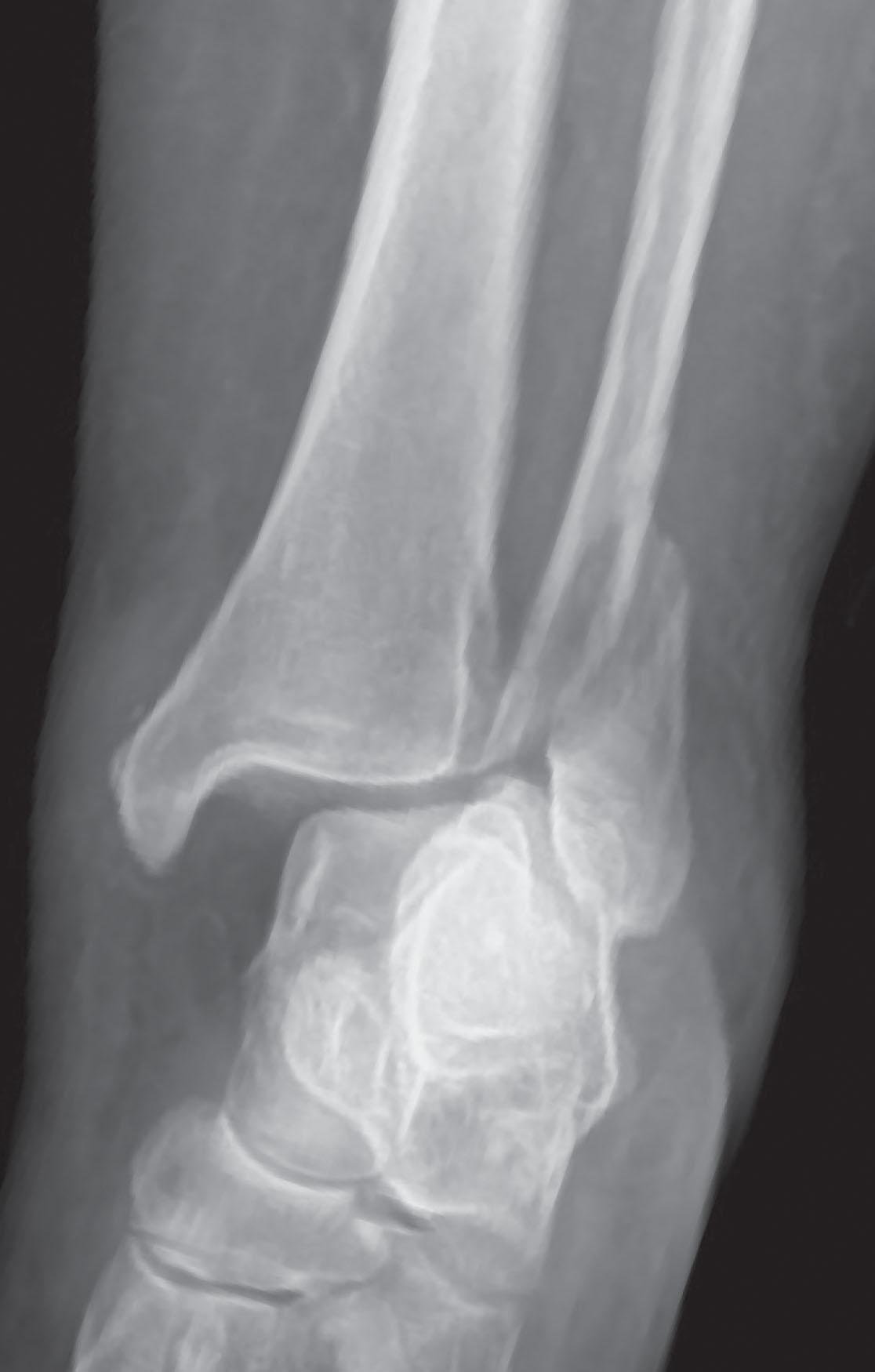 Fig. 44-11, Anteroposterior radiograph demonstrating lateral talar translation with medial clear space widening.