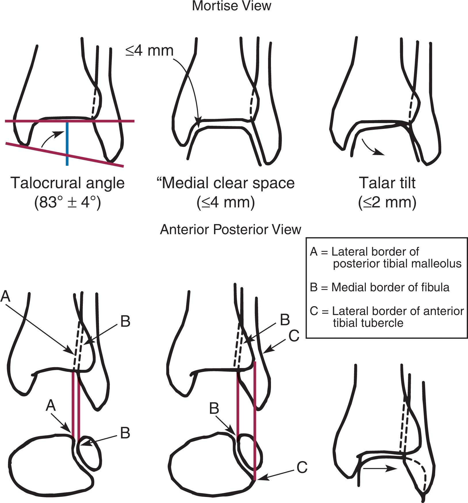 Fig. 44-12, Syndesmosis radiographic criteria.