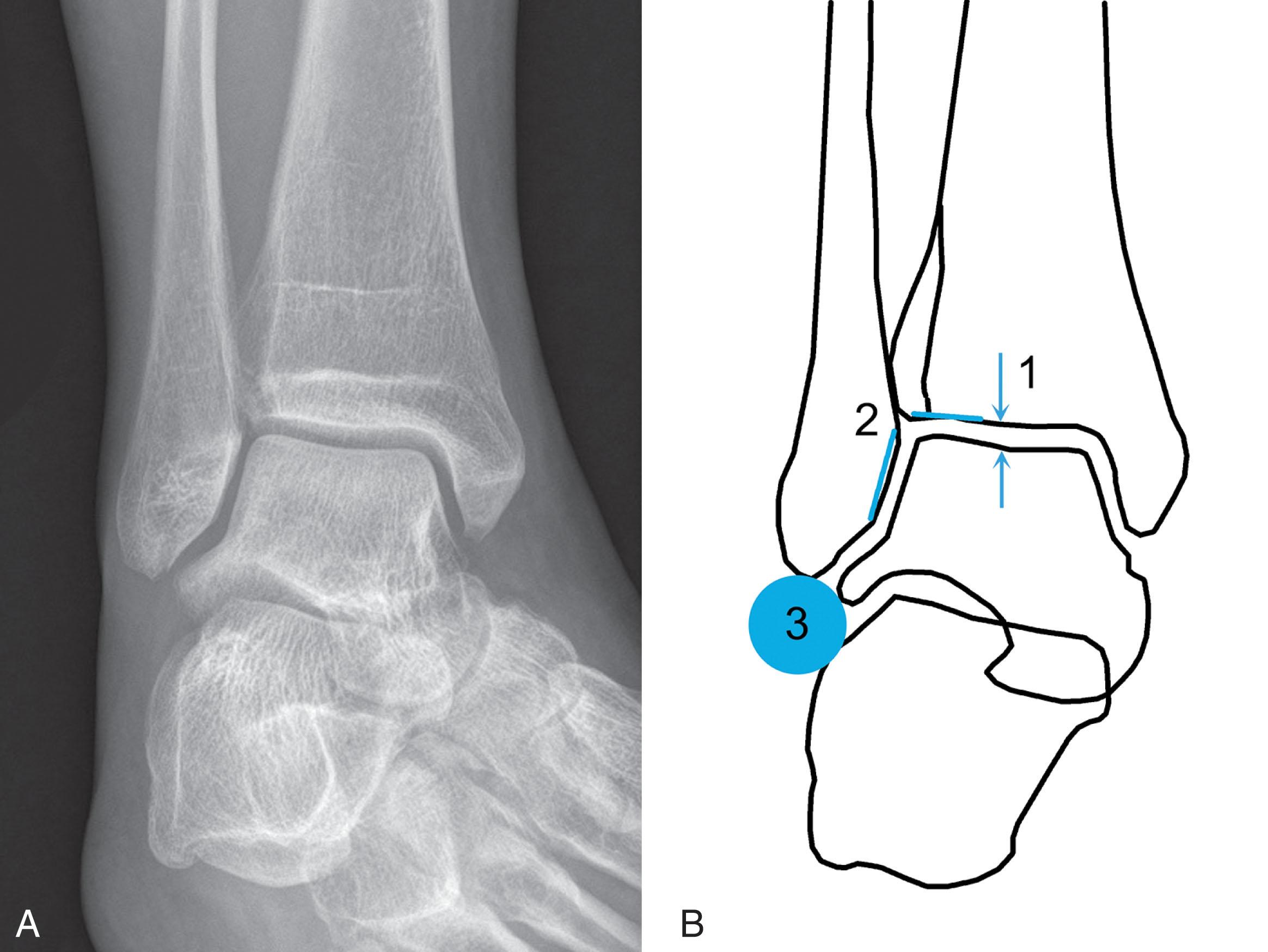 Fig. 44-13, A, Radiographic characteristics of congruently reduced ankle on mortise view. B, 1 , Equidistant and parallel joint space. 2 , Spike of fibula pointing to the level of the subchondral bone of the tibia. 3 , Unbroken curve between the lateral talar articular surface and recess of the distal fibula.