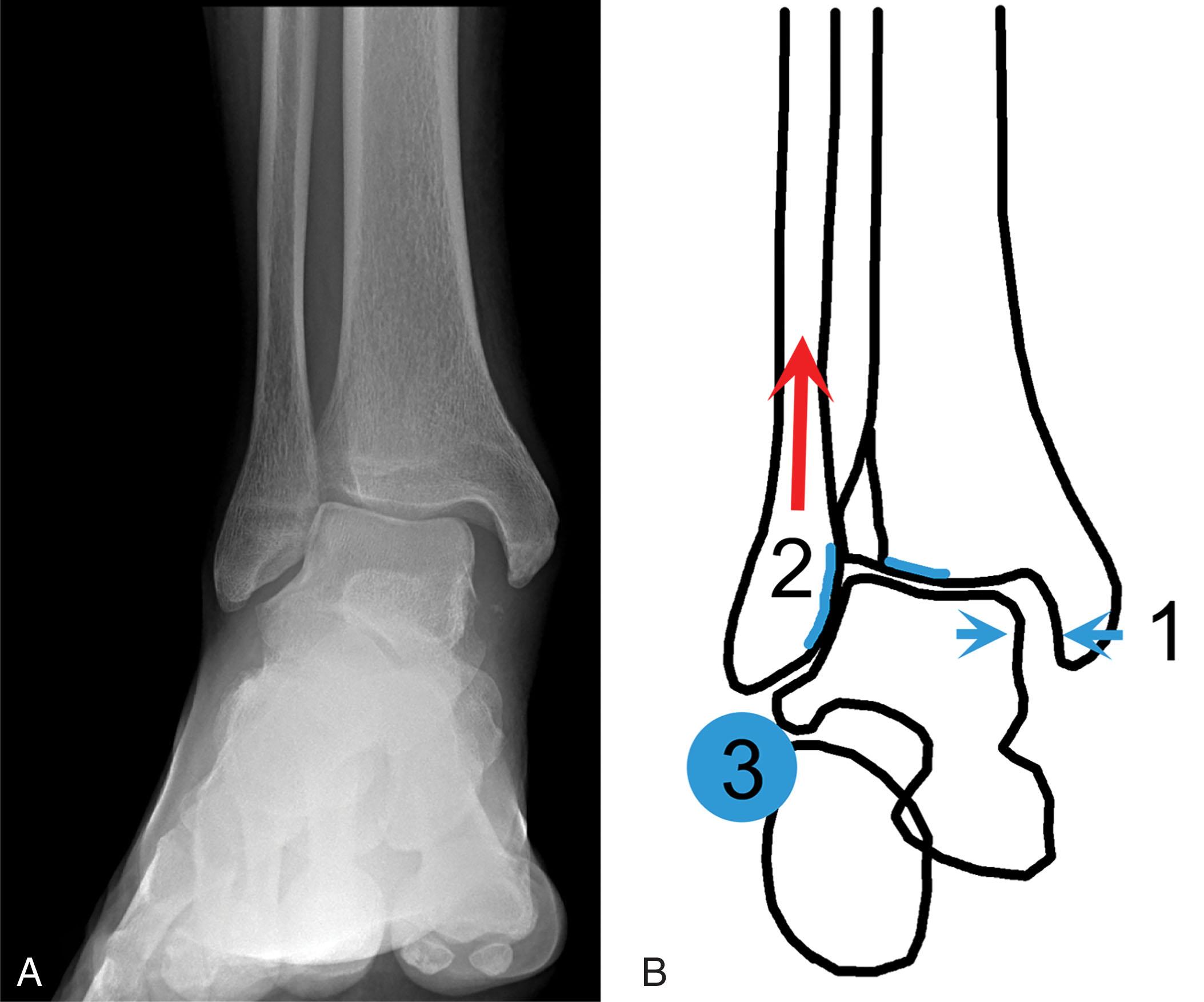 Fig. 44-14, Radiographic characteristics of malreduced fibula on mortise view. The red arrow shows the fibula migrated proximally. 1 , Irregular width of the joint space with widening medially. 2 , Spike of fibula is too proximal. 3 , Broken line from the lateral part of the talus and the distal fibula.