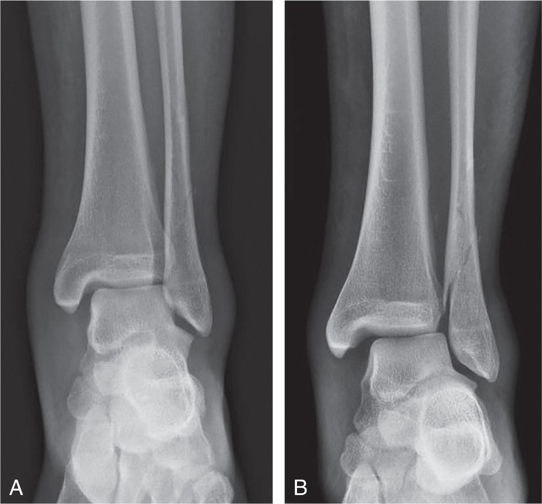 Fig. 44-15, A , Non–weight-bearing ankle radiograph prior to stress examination. B , Manual external rotation stress examination of the ankle demonstrating widening of medial clear space.