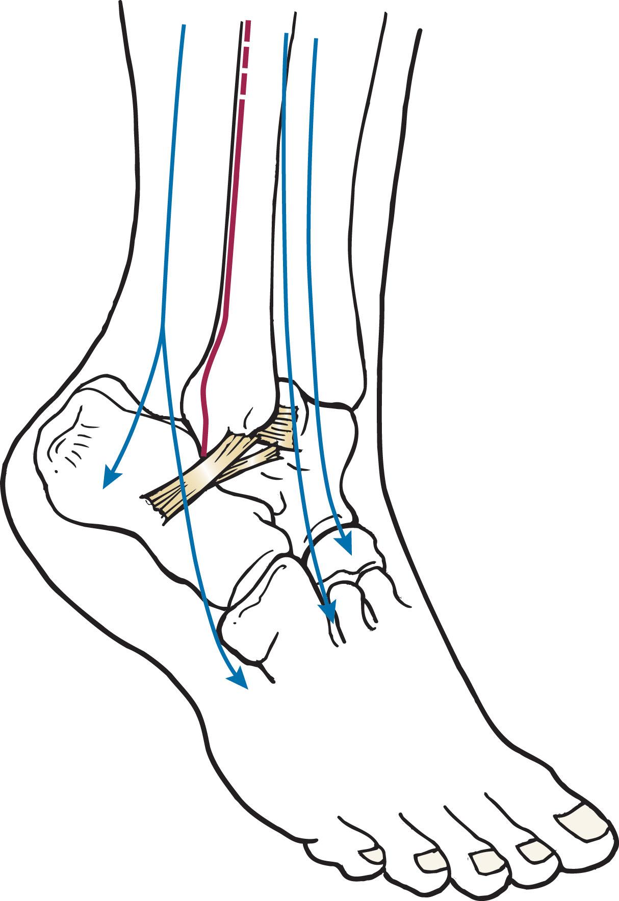 Fig. 44-16, Lateral view. Incision is placed slightly posterior to the fibula, taking care not to damage the superficial peroneal nerve or the sural nerve.