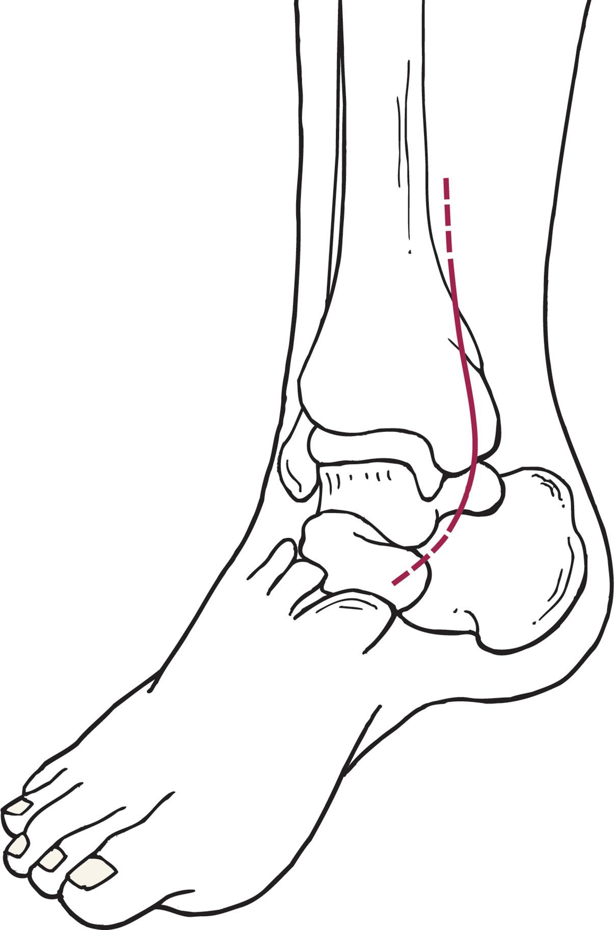 Fig. 44-17, Medial view. The incision runs slightly posterior to the medial malleolus in line with the tibia, curving slightly anteriorly distally to form a gentle J incision. Care must be taken to avoid injury to the saphenous vein and saphenous nerve.