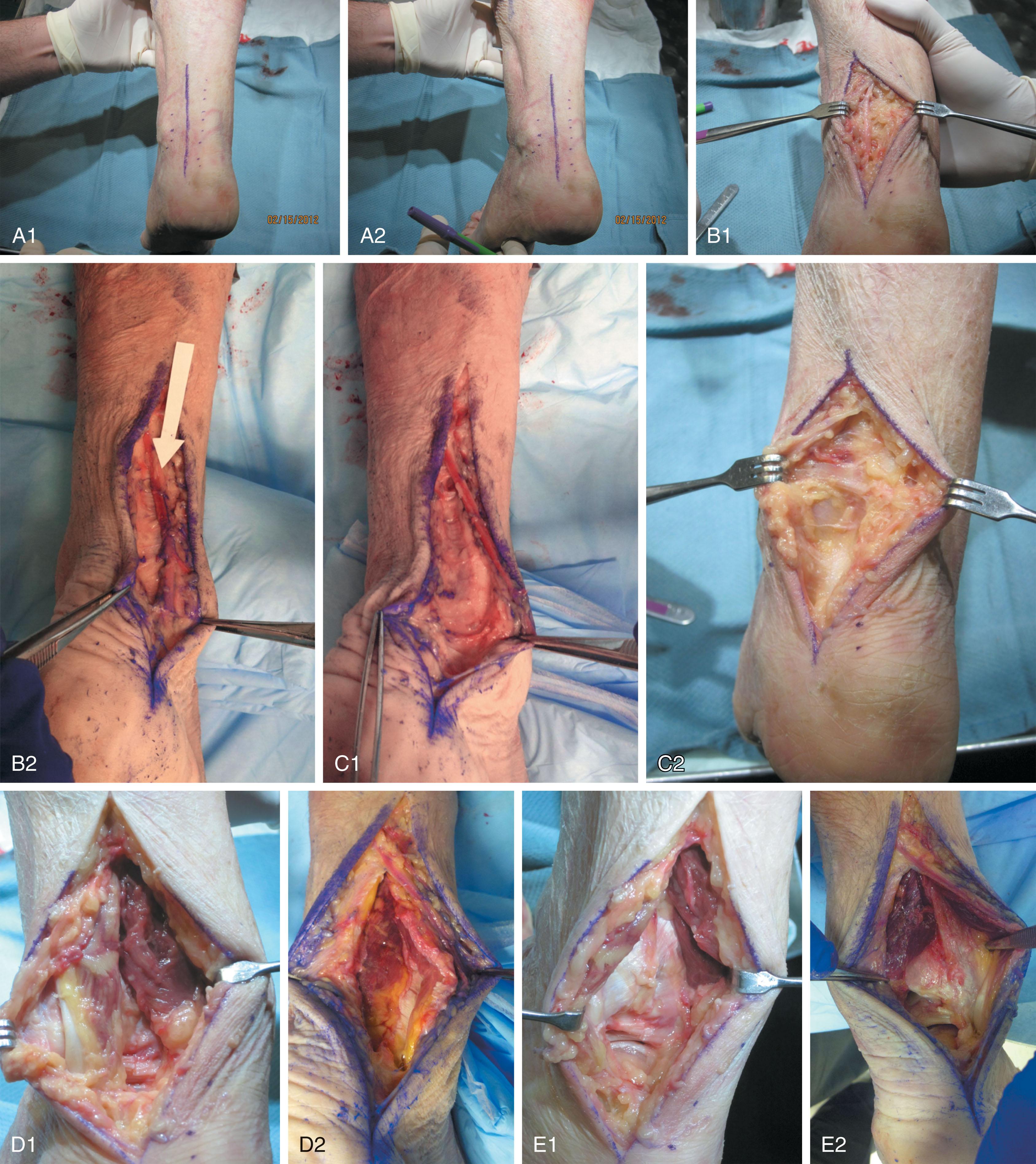 Fig. 44-18, Posterolateral ankle exposure. A1 and A2 , Longitudinal incision is made between posterior fibula and lateral Achilles tendon. B1 and B2 , Sural nerve is identified and protected during superficial dissection. C1 and C2 , Fascia is identified and incised. D1 and D2 , Peroneal tendons and flexor hallucis longus (FHL) muscle are exposed. E1 and E2 , FHL is elevated off interosseous membrane and retracted medially. Peroneal tendons are retracted laterally to expose fibula.