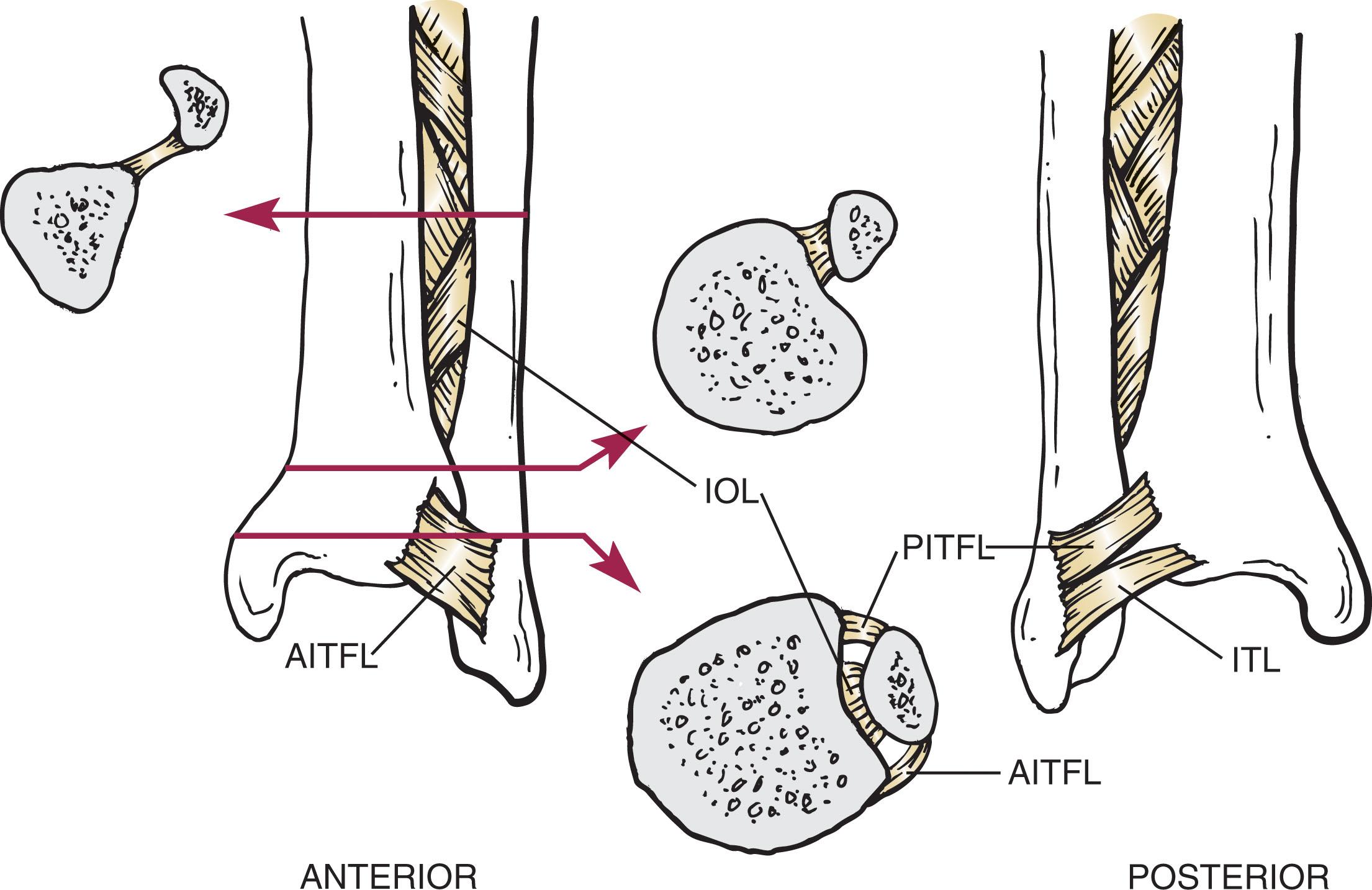 Fig. 44-5, The ligaments of the distal tibiofibular syndesmosis. The lower part of the interosseous membrane thickens to form the interosseous ligament (IOL) . Just above the plafond lie the anterior inferior tibiofibular ligament (AITFL) and the posterior inferior tibiofibular ligament (PITFL) , with more distal fibers called the inferior transverse ligament (ITL) .